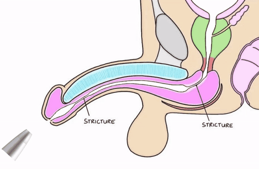 Uttarbasti Procedure